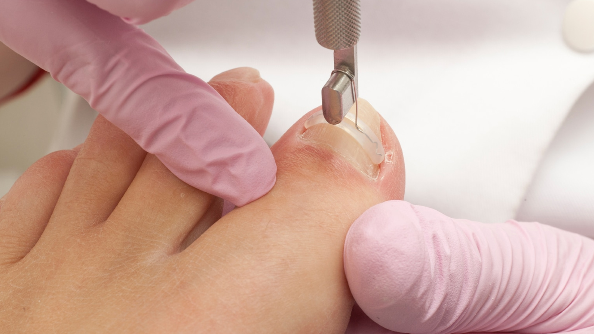  Nail Brace